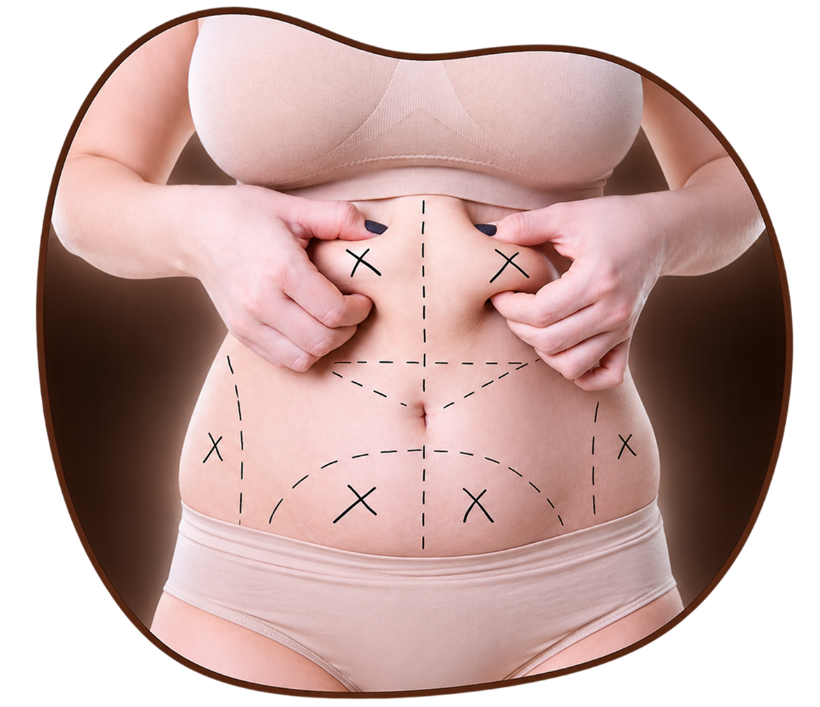 Liposuction